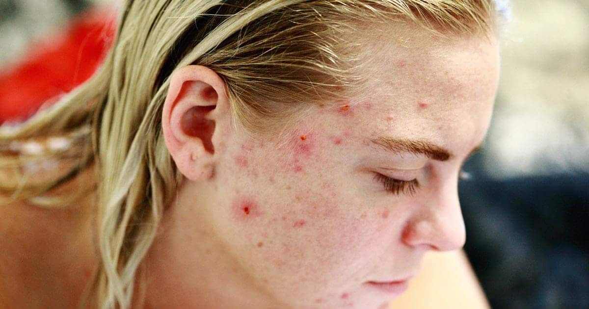 ชนิดของสิว, สิวแต่ละประเภท