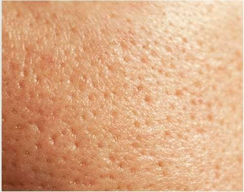 รูขุมขนกว้างเกิดจาก, วิธีแก้หน้ามัน รูขุมขนกว้าง