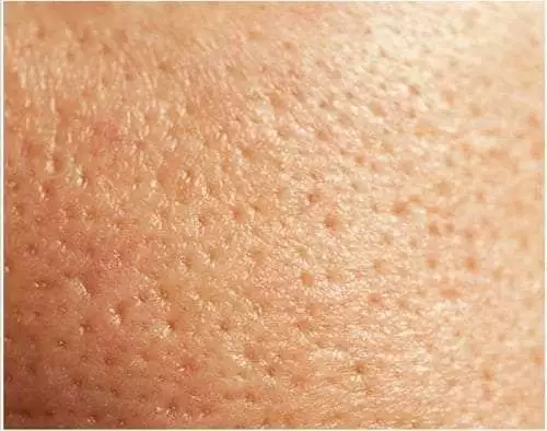 รูขุมขนกว้างเกิดจาก, วิธีแก้หน้ามัน รูขุมขนกว้าง