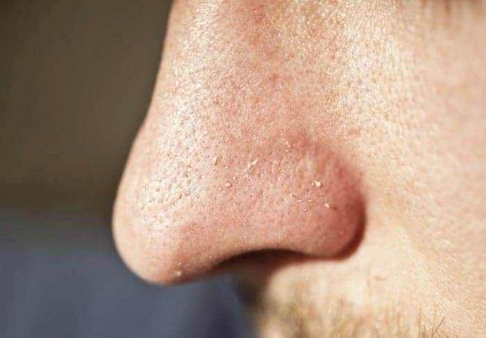 ชนิดของสิว, สิวแต่ละประเภท