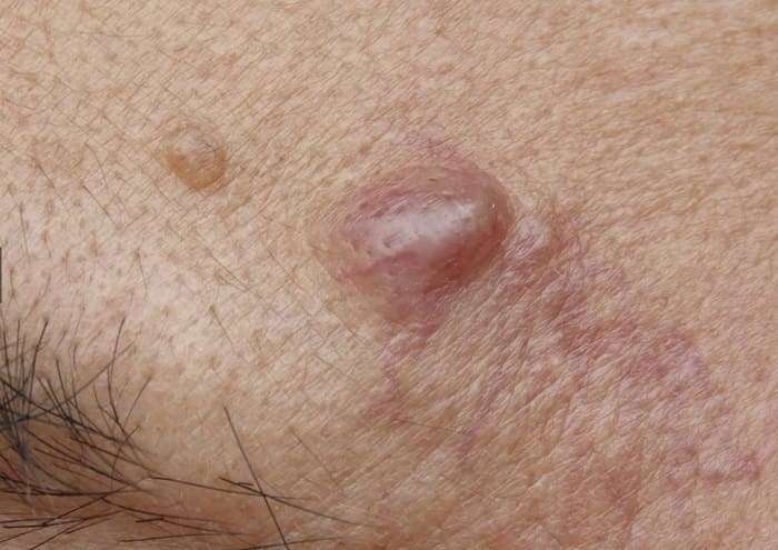 ชนิดของสิว