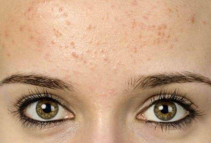 ชนิดของสิว, สิวแต่ละประเภท