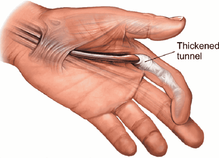 นิ้วล็อกเกิดจาก, อาการนิ้วล็อกมือชา