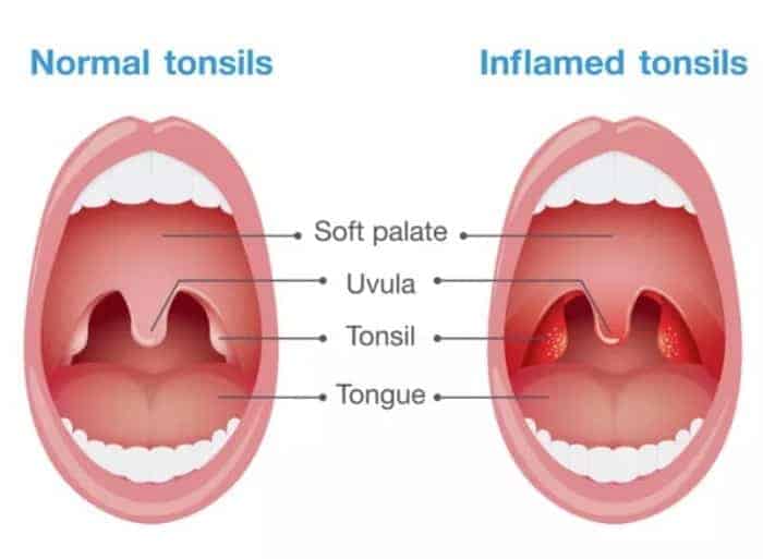 อาการต่อมทอนซิลอักเสบ, ทอนซินอักเสบเกิดจาก