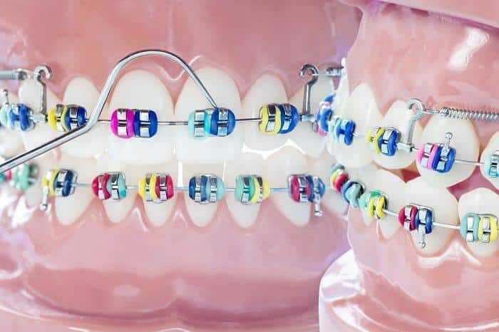 ดัดฟันใสราคา, ดัดฟันมีกี่แบบ