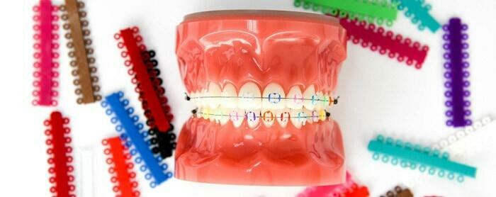 ดัดฟันใสราคา, ดัดฟันมีกี่แบบ