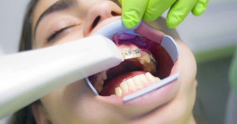 ดัดฟันใสราคา, ดัดฟันมีกี่แบบ