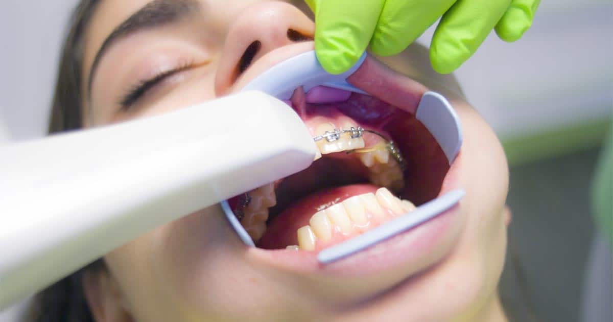 ดัดฟันใสราคา, ดัดฟันมีกี่แบบ