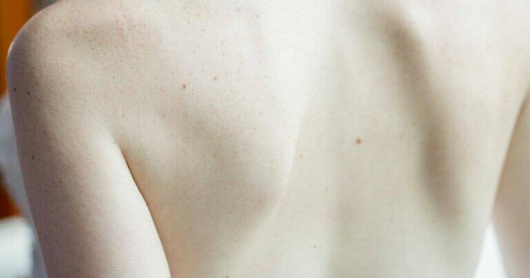 แก้สิวที่หลัง, ยาทาสิวที่หลัง