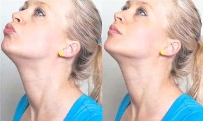 ลดแก้มลดเหนียง, วิธีลดแก้มเหนียง